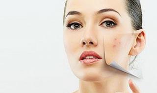 痘印如何祛除 痘印怎么消除小妙招